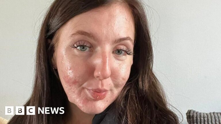 Acne fighter films her skin journey to help others